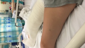 Right leg in a plaster cast