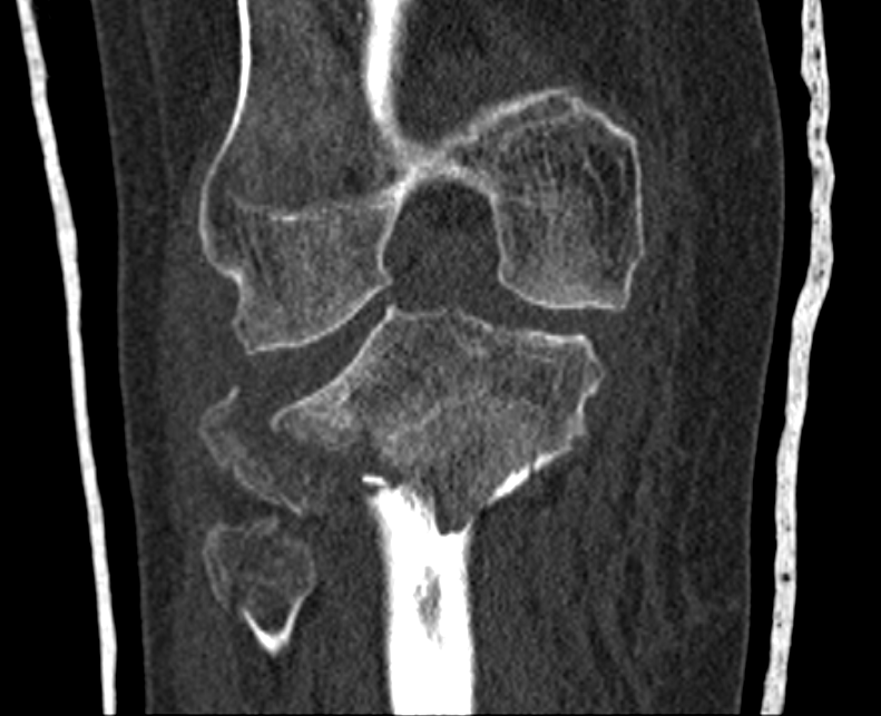Ct scan of a fractured Knee