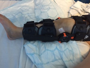 First brace given black with foam pads as support and Velcro straps leg is extremely bruised and swollen