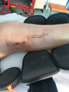 Leg with 17 stables closing two long cuts down the right side of the leg