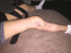 Leg without staples or brace on, 2 long cuts with visible staple holes and scabbing